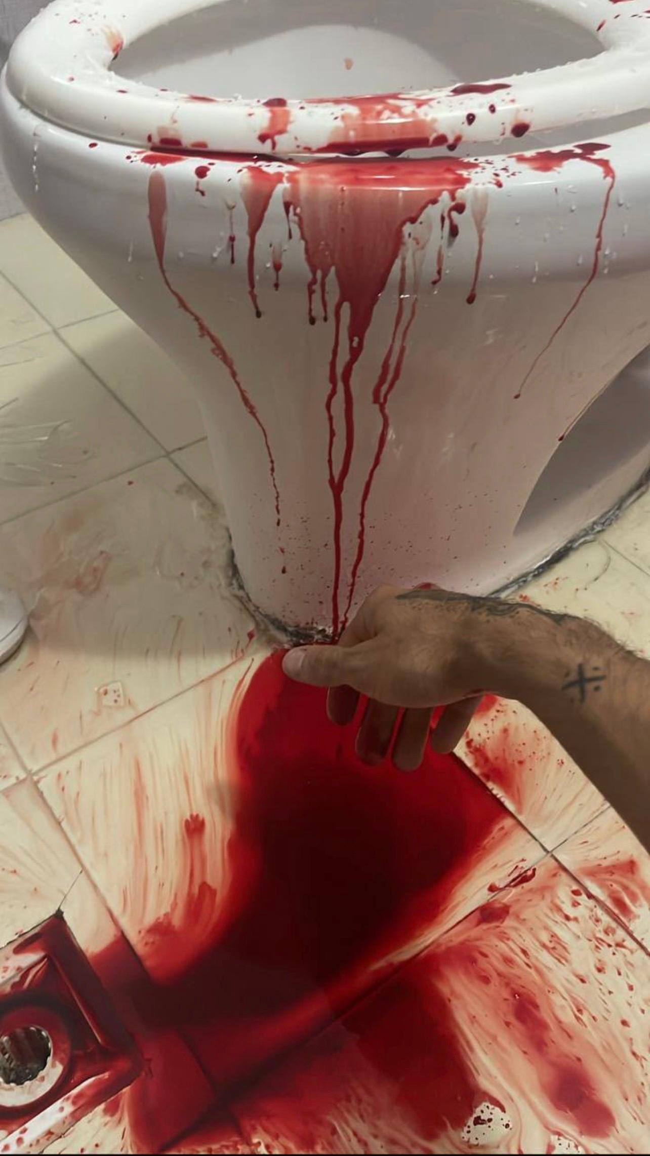Erfan Nabian removes pellets from his body after being shot during protests in Isfahan on January 8, 2026.