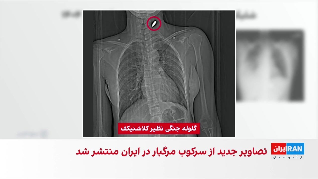 شلیگ گلوله به سر،سینه و اندام جنسی