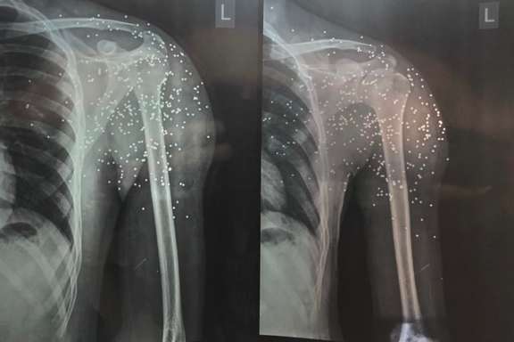Sixteen-year-old protestor in Iran with multiple pellets in the left shoulder and few in the chest has lost the ability to move his arm due to permanent nerve injury. (Photo by Dr. Kayvan Mirhadi)