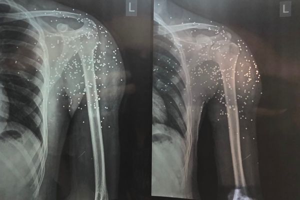 Wounded Iran Protesters Avoid Hospitalization In Fear Of Arrest