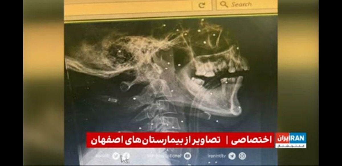 Hospital X-ray exclusively obtained by Iran International shows shot pellets lodged in the skull of a protester.