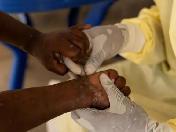 اِمپاکس به خارج از آفریقا رسید؛ شناسایی ۲ مبتلا در پاکستان و سوئد