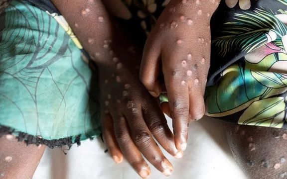 سازمان بهداشت جهانی شیوع آبله میمون را وضعیت اضطراری جهانی اعلام کرد