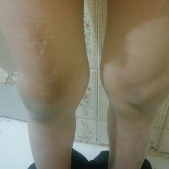 The kid who was burned by clothing-iron at the center