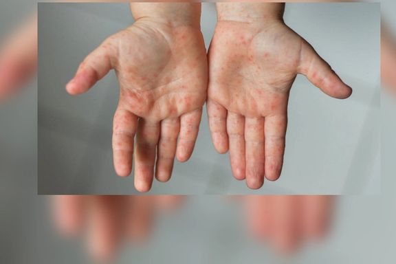 وزارت بهداشت نسبت به افزایش ابتلا به سرخک در کشور هشدار دارد