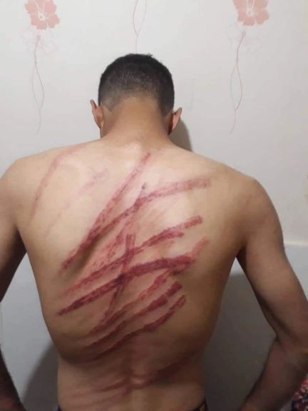 Baton marks on the back of a protester