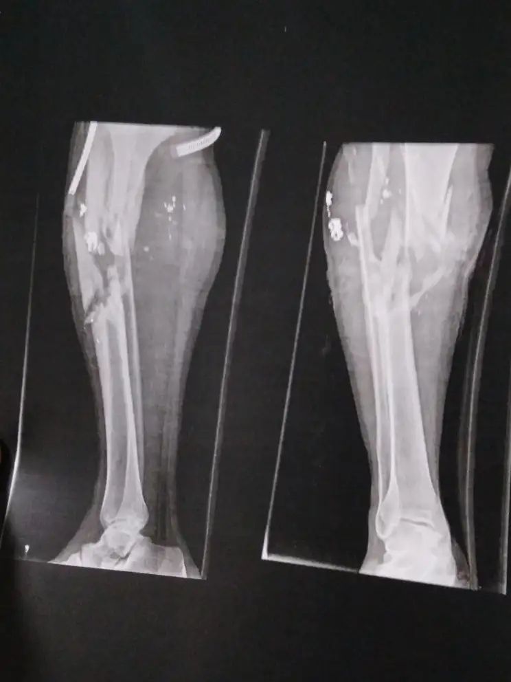 An X-ray provided shows extensive damage to the lower leg of a 34-year-old protester who was shot in Qazvin on January 8.