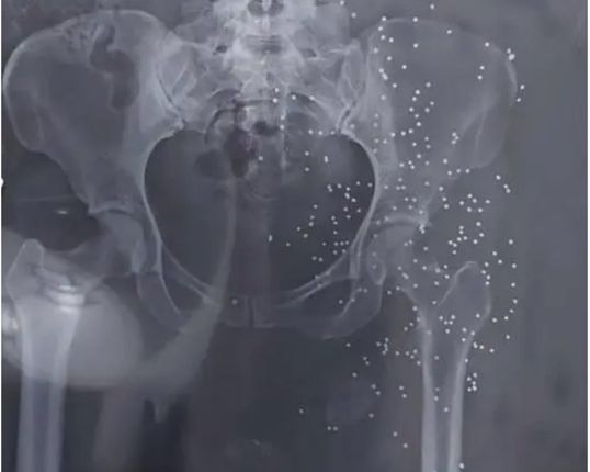 An x-ray image showing the genitals of a protester targeted by shotgun.
