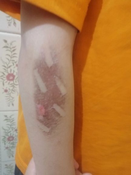 The kid who was burned by clothing-iron at the center
