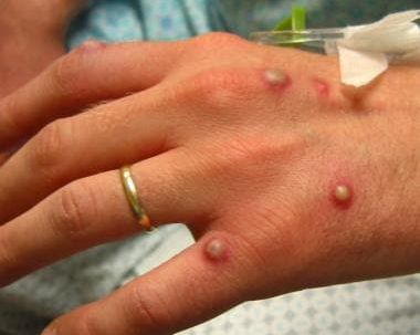 آبله میمون؛ چهار سوال مهمی که دانشمندان درباره بیماری از خود میپرسند