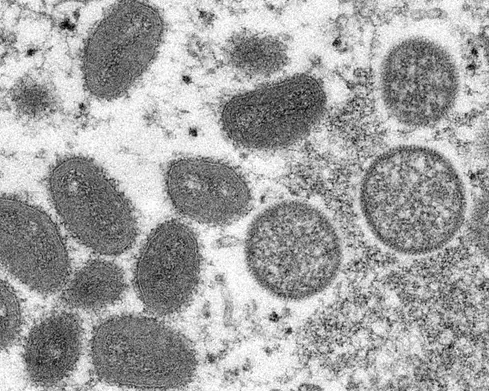 مرکز بیماریهای عفونی دانشگاه بهشتی: هیچ مورد تایید شدهای از آبله میمونی در ایران نداریم