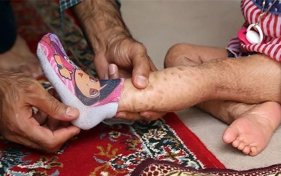 مدیرعامل بنیاد بیماریهای نادر: ۱۰ بیماری نادر جدید در ایران شناسایی شده است