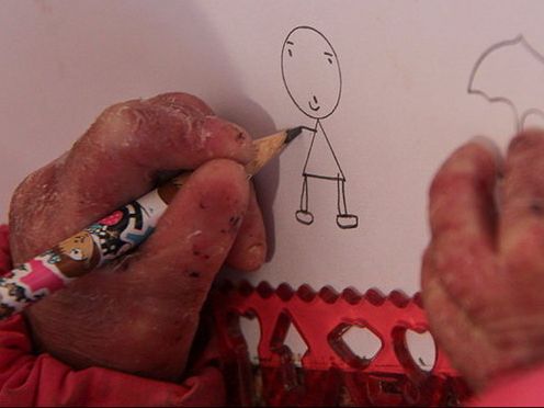 خانه بیماران پروانهای: بخشی از ۶ تن پانسمان وارداتی آلمان در بازار آزاد خریدوفروش میشود