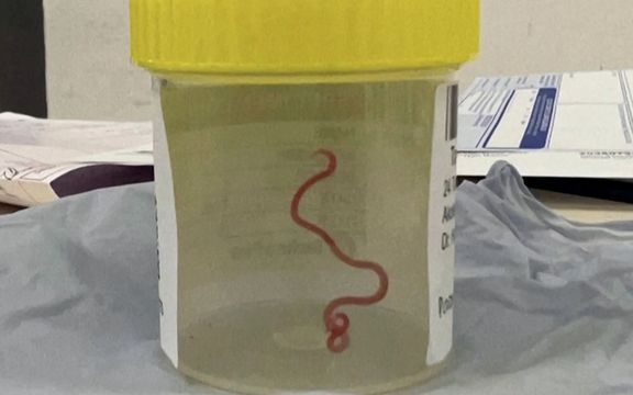 در یک اتفاق بیسابقه در استرالیا یک کرم زنده ۸ سانتیمتری از مغز یک زن بیرون آورده شد