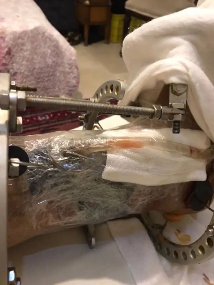 The injured Iranian protester undergoes treatment with an external fixation device after suffering a gunshot wound to the leg during demonstrations on January 8.