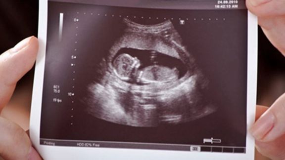 روزنامه شرق: به خاطر ممنوعیت غربالگری دولت، در یک مرکز ۱۲ نوزاد معلول متولد شدند