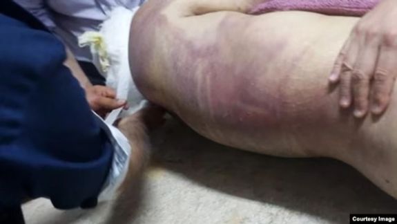 This photo shows the injuries and bruises on Peyman Galvani's back.