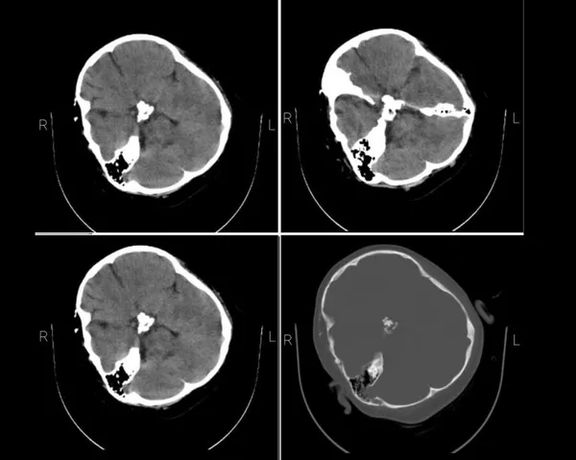 Mahsa Amini's CT scan that hospital staff made available to Iran Internation on September 19, 2022