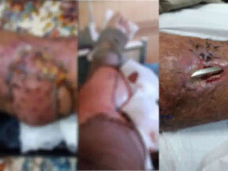 The wounded protester receives hospital treatment after being shot during January demonstrations in Isfahan. The patient has undergone 25 surgeries and continues to suffer from a severe infection.