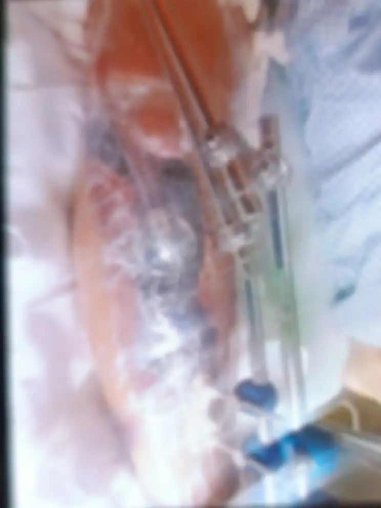 Images show the protester’s injured leg during months of treatment following the shooting. The gunshot shattered bone and severed a nerve and tendon, requiring repeated surgeries and extensive wound care.