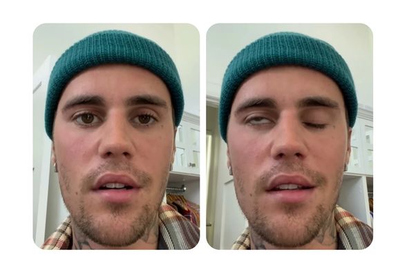 جاستین بیبر به دلیل فلج شدن نصف صورتش کنسرتهایش را لغو کرد