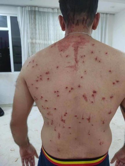 A man shot with 'birdshots' from a shotgun in Ilam on Septemebr 20, 2022