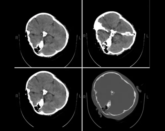 تایید اصالت تصاویر افشا شده در ایران اینترنشنال از سیتیاسکن مهسا امینی از سوی فارس