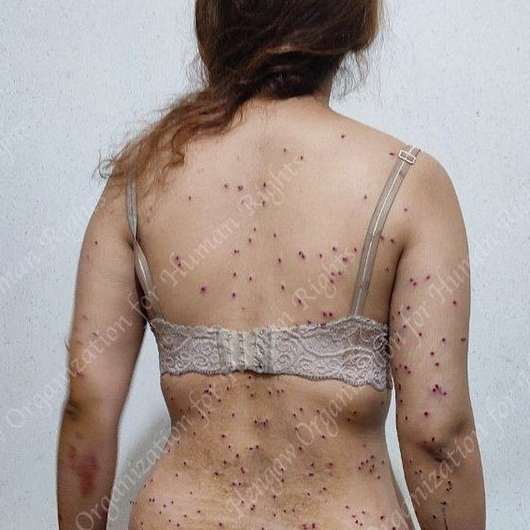 A woman shot in Tehran in October with shotgun pellets