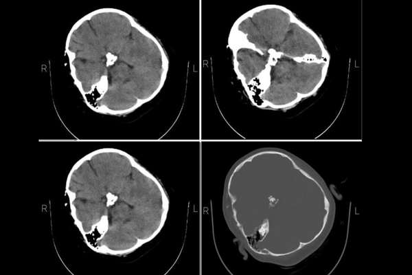 Mahsa Amini’s CT Scan Shows Skull Fractures Caused By Severe Blows