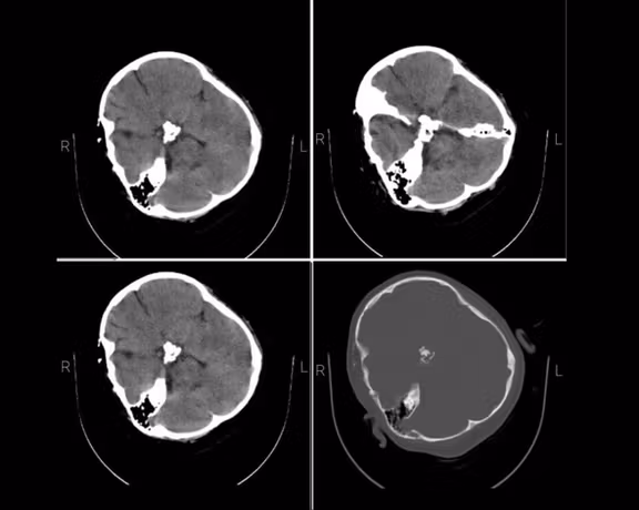 The skull CT scan of Mahsa Amini