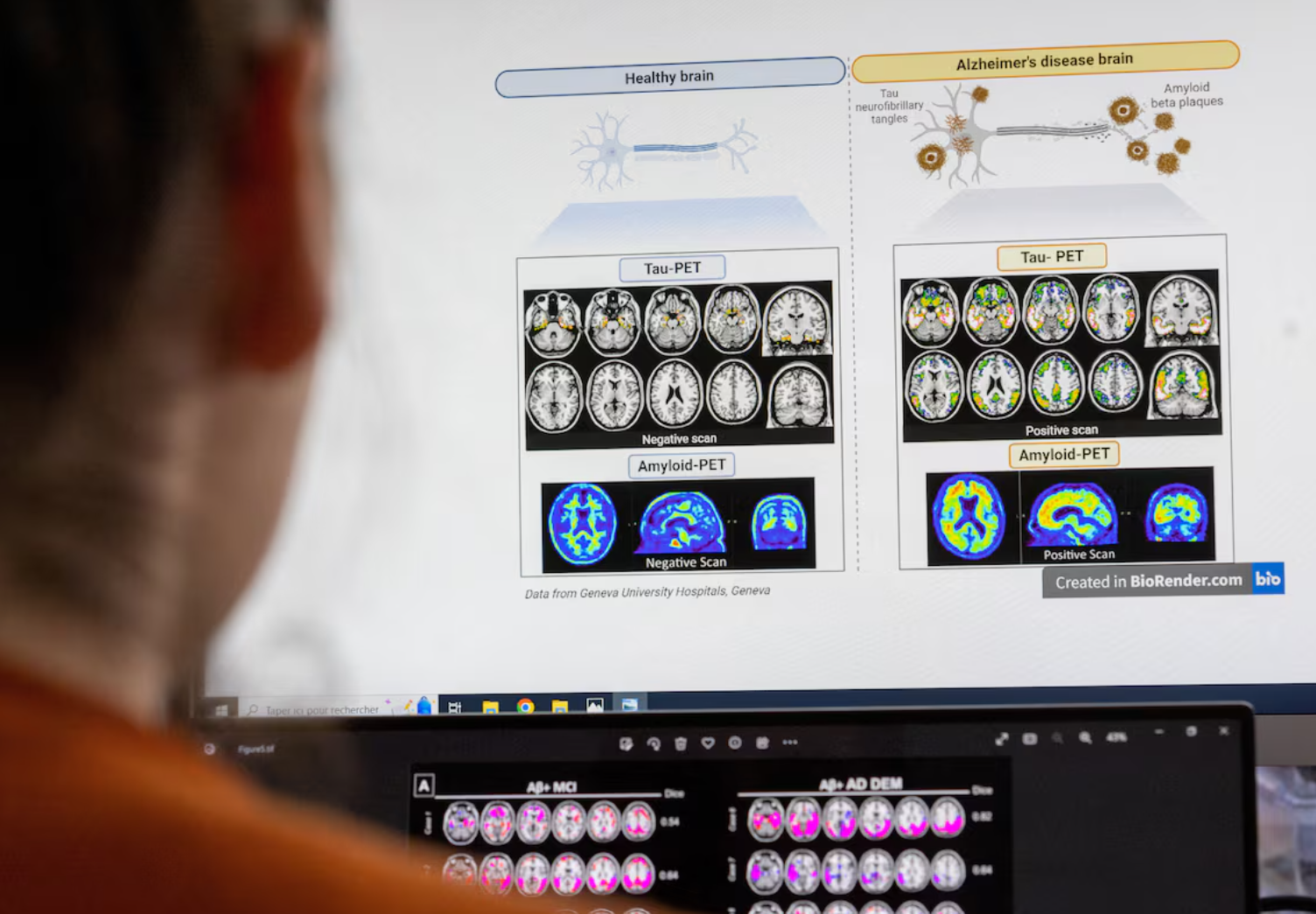 کشف نقش یک پروتئین خاص در ارتباط بین سلول‌های مغزی امیدها به درمان آلزایمر را افزایش داد