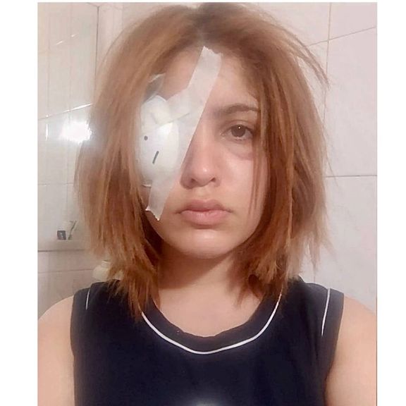 عسل جزیده، از آسیبدیدگان چشمی خیزش انقلابی، برای درمان از ایران خارج شد