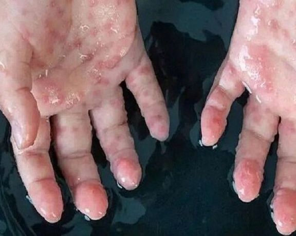 معاون دانشگاه علوم پزشکی قم: تست یک کودک مشکوک به آبله میمون منفی بود